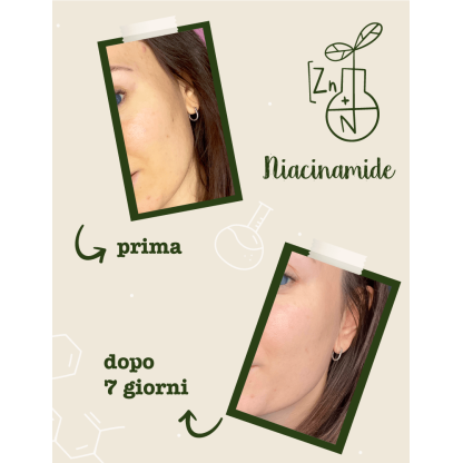 Niacinamide + Zinco