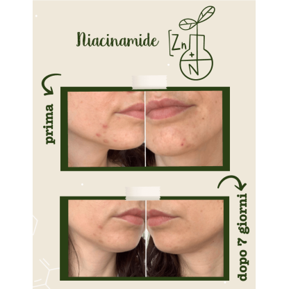 Niacinamide + Zinco