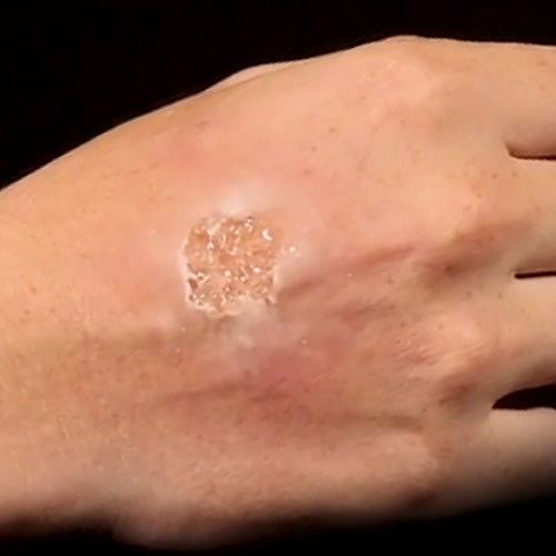 Gel per vesciche - Blister Gel