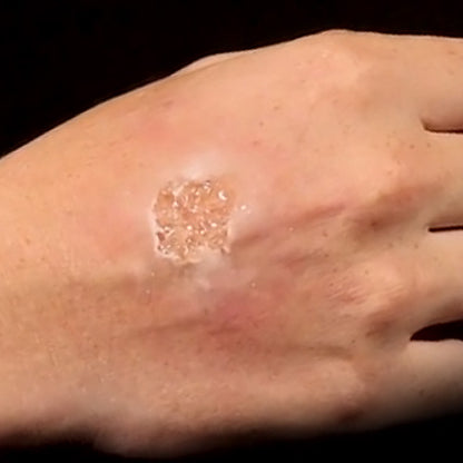 Gel per vesciche - Blister Gel