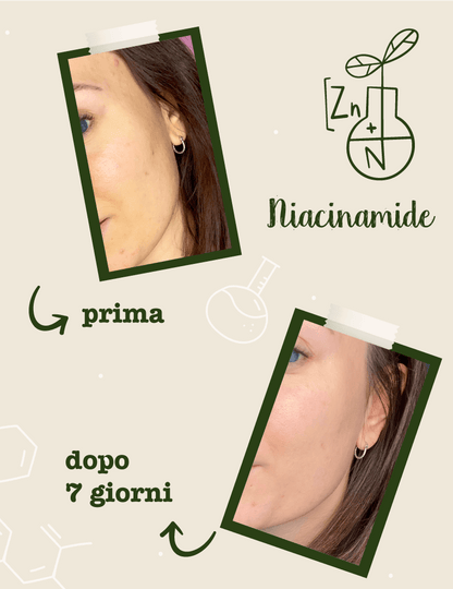 Niacinamide + Zinco Siero Viso Seboregolatore Anti-Imperfezioni