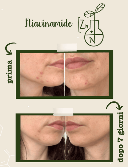 Niacinamide + Zinco Siero Viso Seboregolatore Anti-Imperfezioni