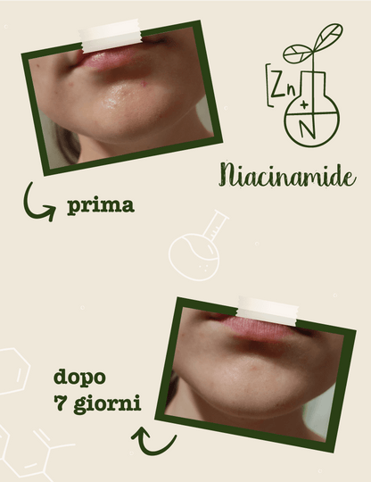 Niacinamide + Zinco Siero Viso Seboregolatore Anti-Imperfezioni