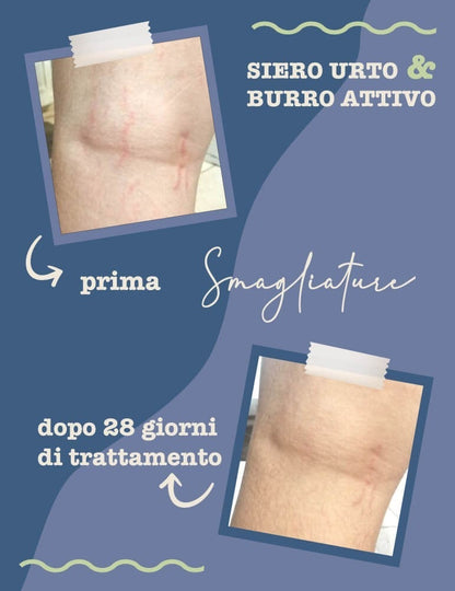 Siero Urto Smagliature - Migliora Elasticità e Riduce Visibilità