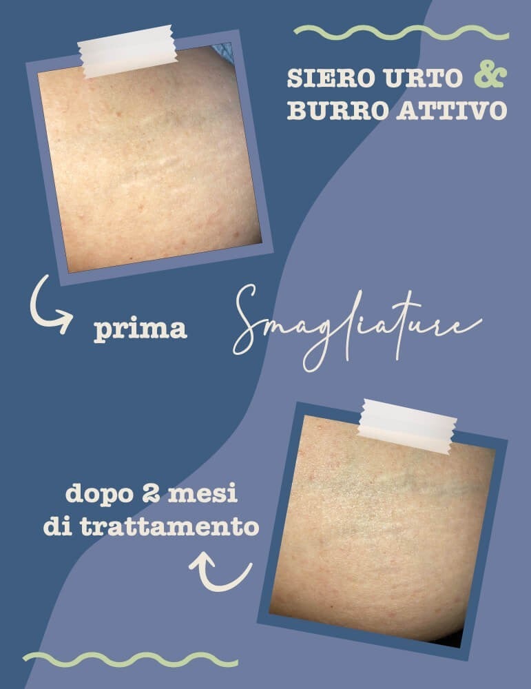Siero Urto Smagliature - Migliora Elasticità e Riduce Visibilità